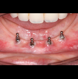 Mini Dental Implants at Lower Jaw